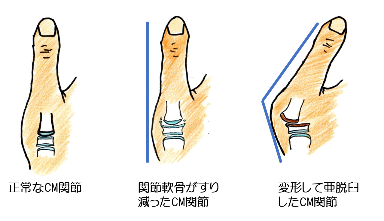 親指の付け根が動かすと痛い！それは母指CM関節症かもしれません!? すみだ整骨院 直方,飯塚,田川,八幡で整骨院なら