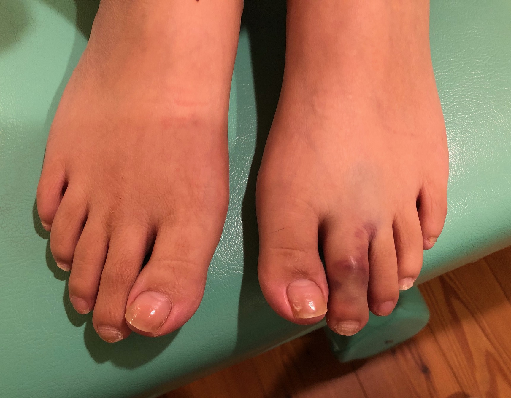 薬指 足 の 指 痛い 足の中指や薬指が痛い原因はモートン病かもしれません